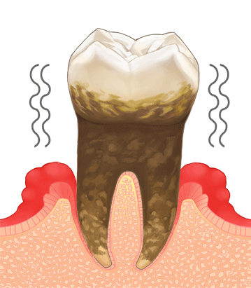 歯周病重度