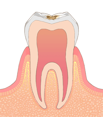 虫歯中期